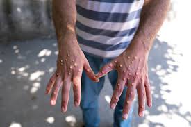South Africa plans Mpox handling education for funeral parlours
